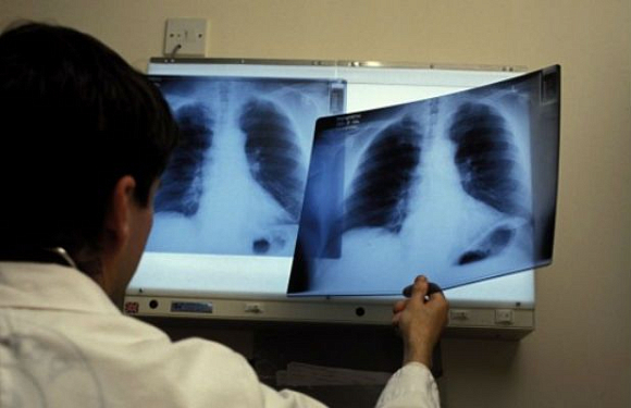 Каждый 20-й житель Пензенской области страдает болезнями легких