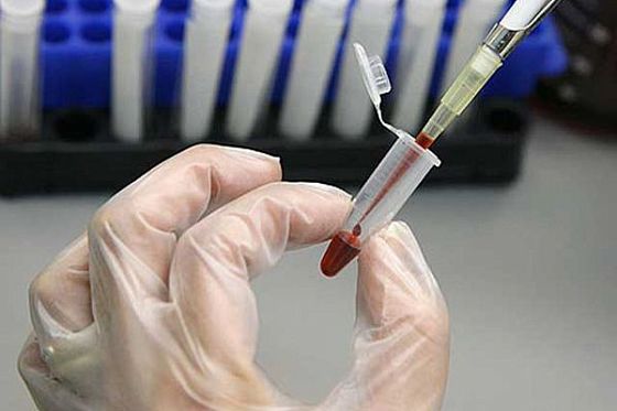 Пензенцев призывают бесплатно и анонимно сделать тест на ВИЧ