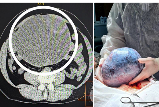 У зареченки удалили из живота гигантскую опухоль