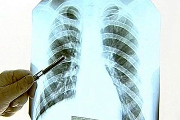 В Пензенской области на 12% снизилась заболеваемость туберкулезом