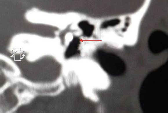 Осколок металла оказался за барабанной перепонкой || Фото instagram.com/hospital6pnz В Пензе врачи нашли за барабанной перепонкой сварщика осколок металла